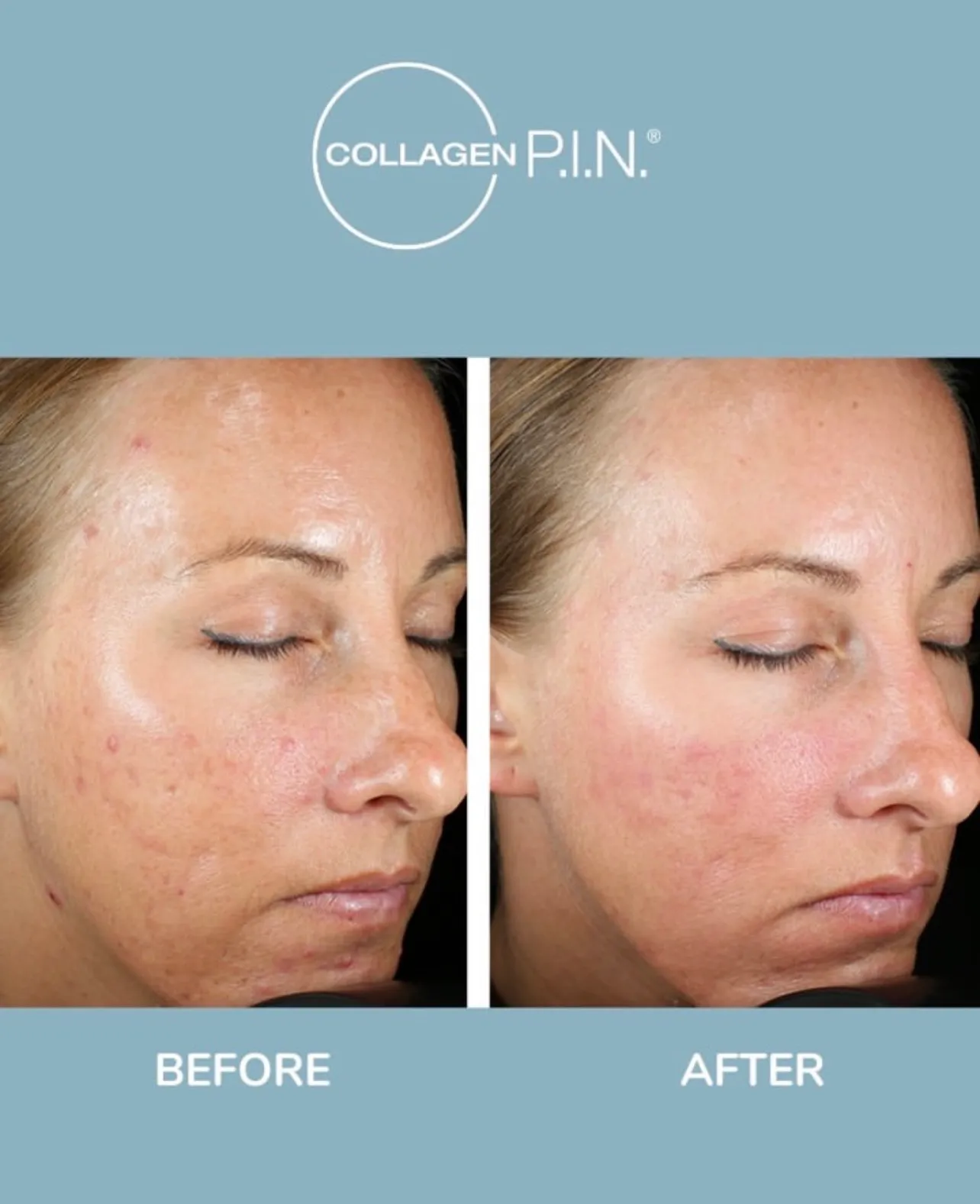 Microneedling with PRP before and after showing smoother skin texture and softened fine lines