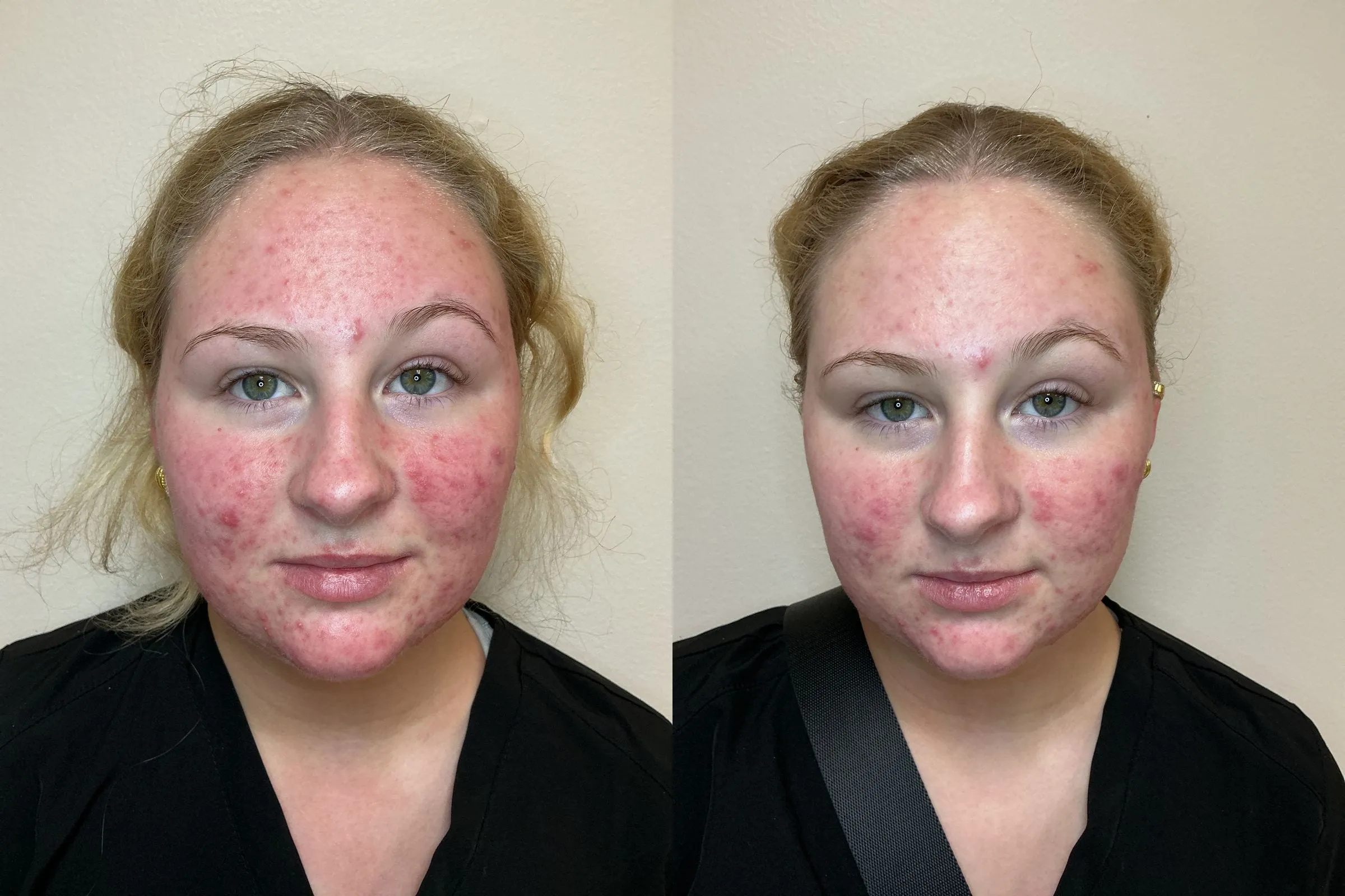 Front view before and after a single Environ Cool Peel treatment, showing clearer skin with fewer active breakouts across the cheeks and forehead