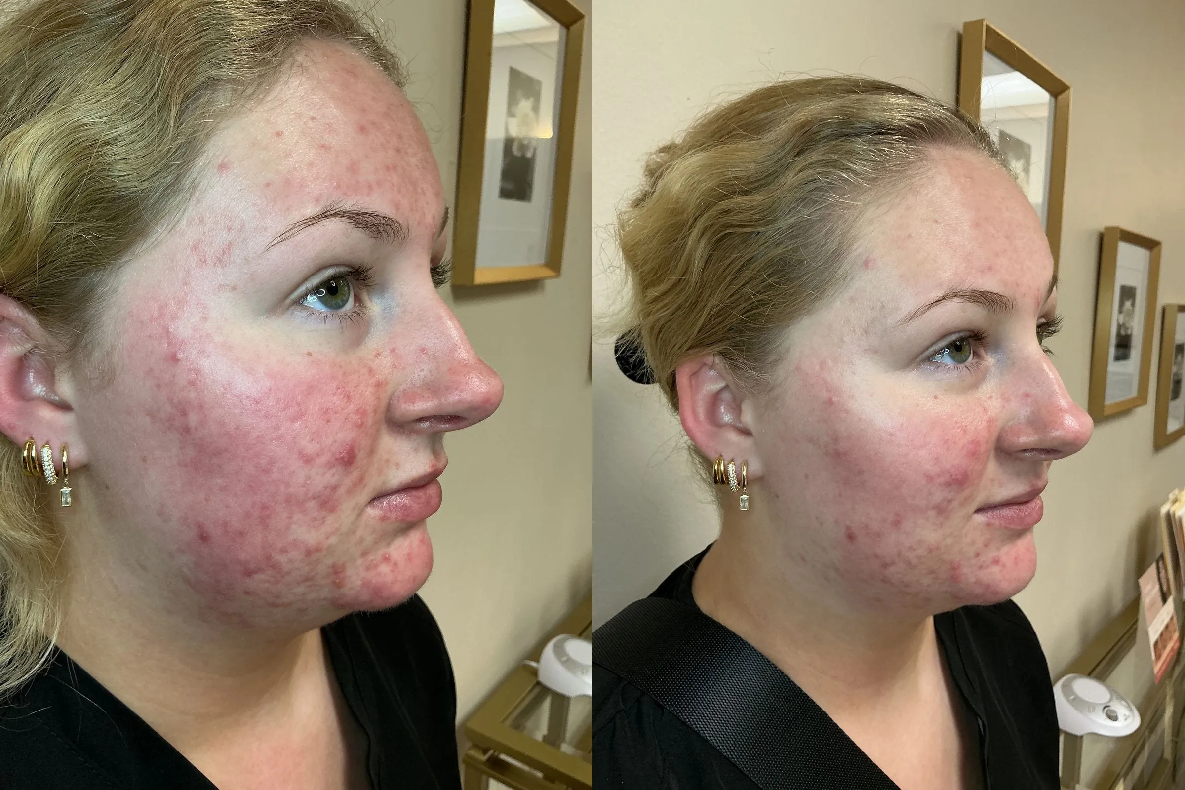 Side profile before and after a single Environ Cool Peel treatment, showing calmer, clearer skin across the cheek and jawline