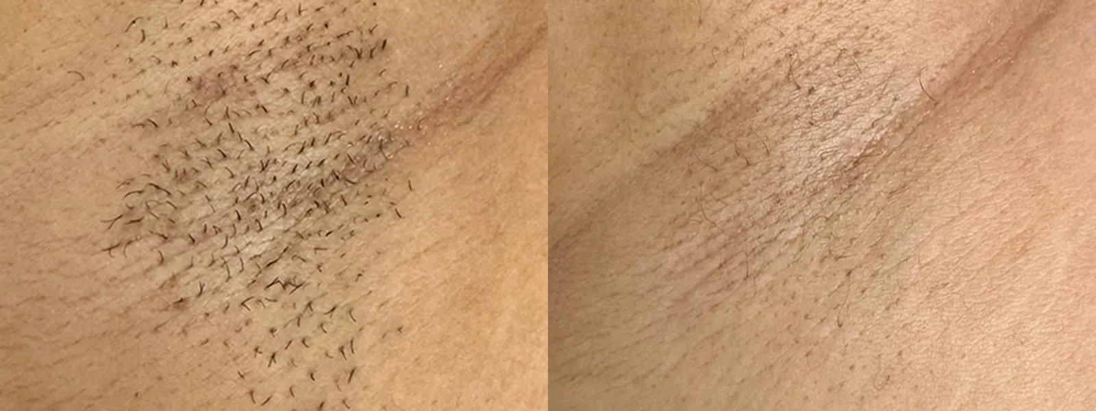 Laser hair removal before and after on the underarm showing dramatically reduced hair after Fusion treatment
