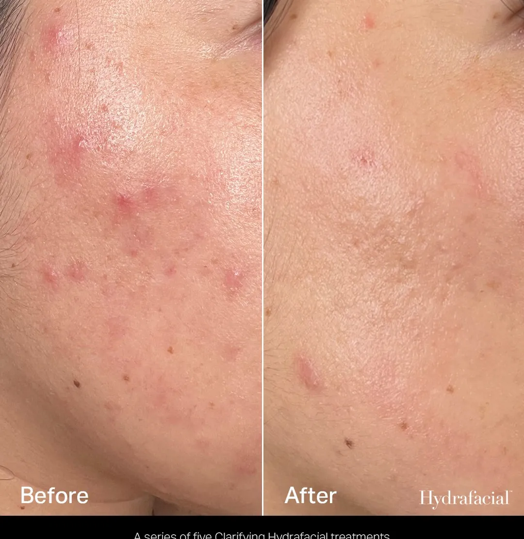 HydraFacial before and after showing clearer skin with reduced acne, congestion and redness