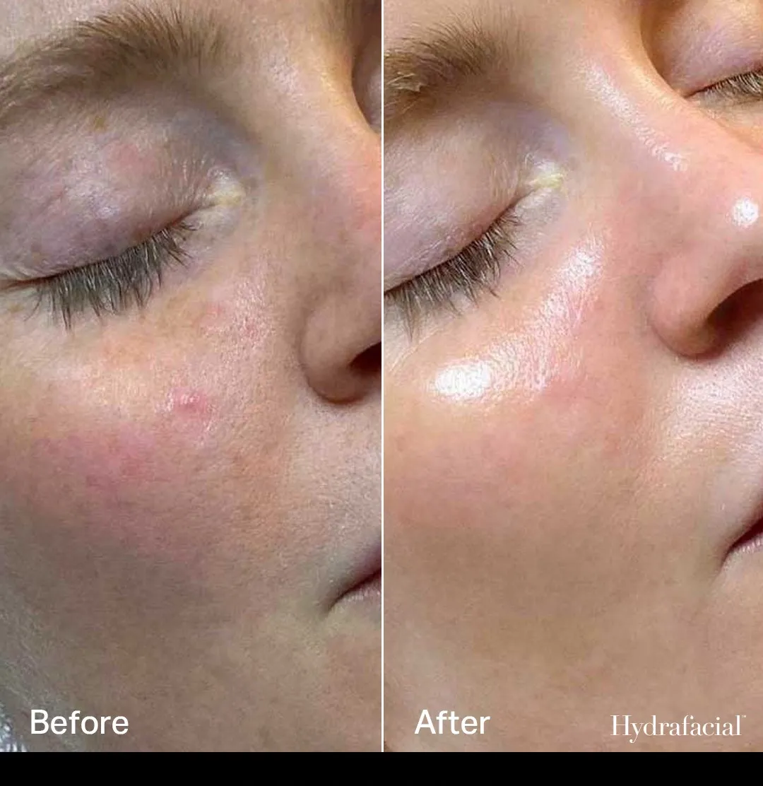 HydraFacial before and after showing brighter, more radiant skin and reduced dullness after treatment