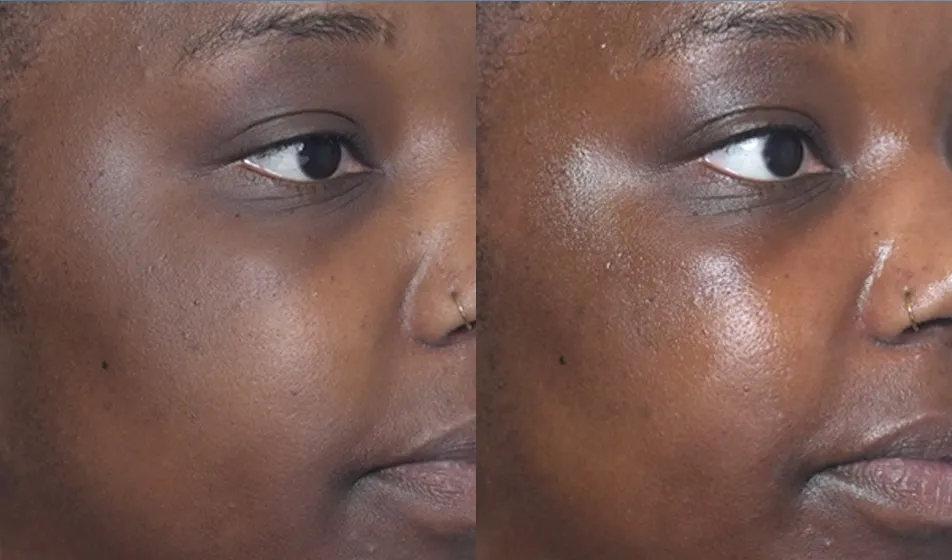 HydraFacial before and after showing boosted hydration and glow from the Hydralock HA booster