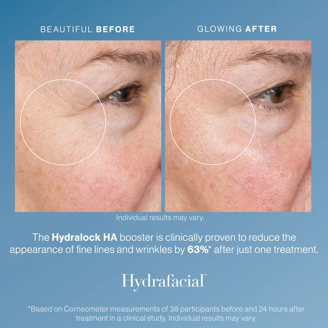 HydraFacial clinical results infographic. Fine lines and wrinkles reduced 63% after one treatment