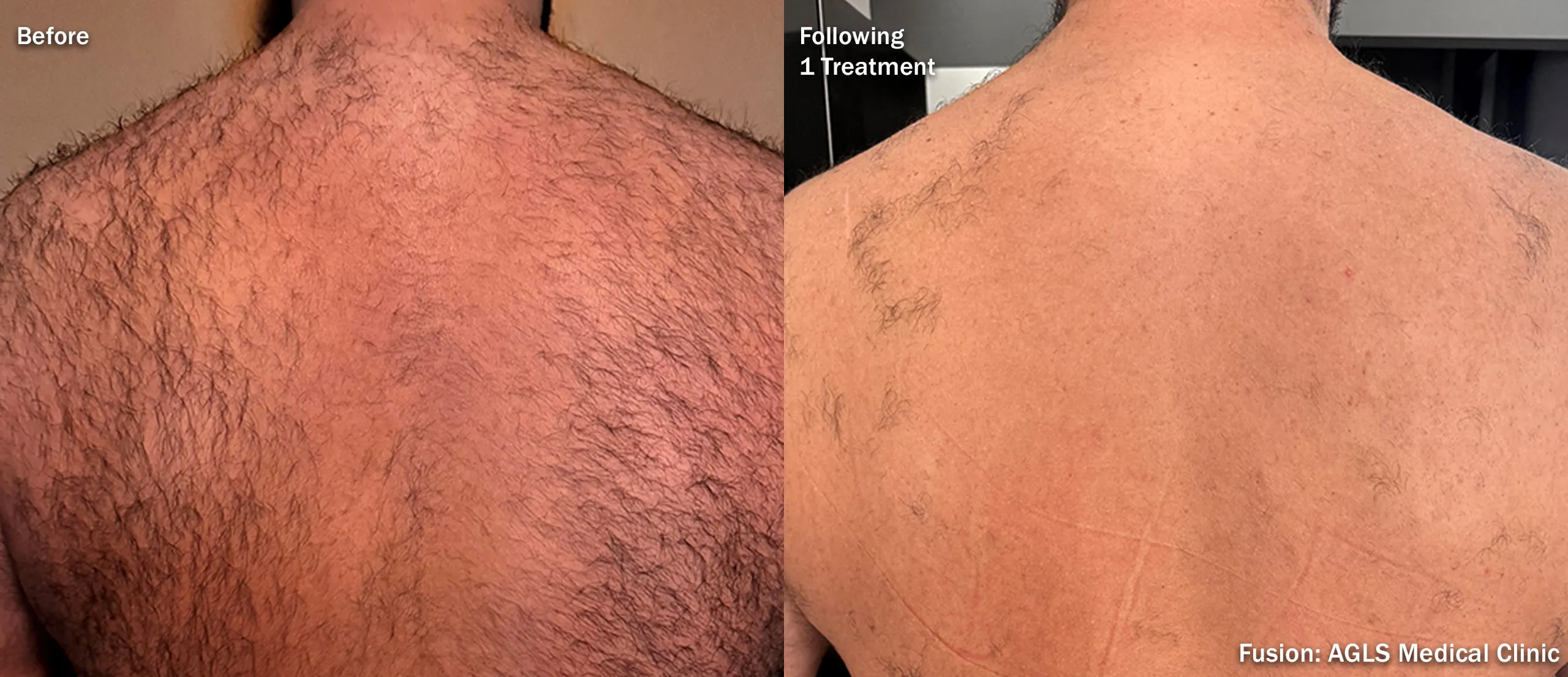 Laser hair removal before and after on a man’s back showing dramatically reduced hair after a single Fusion session