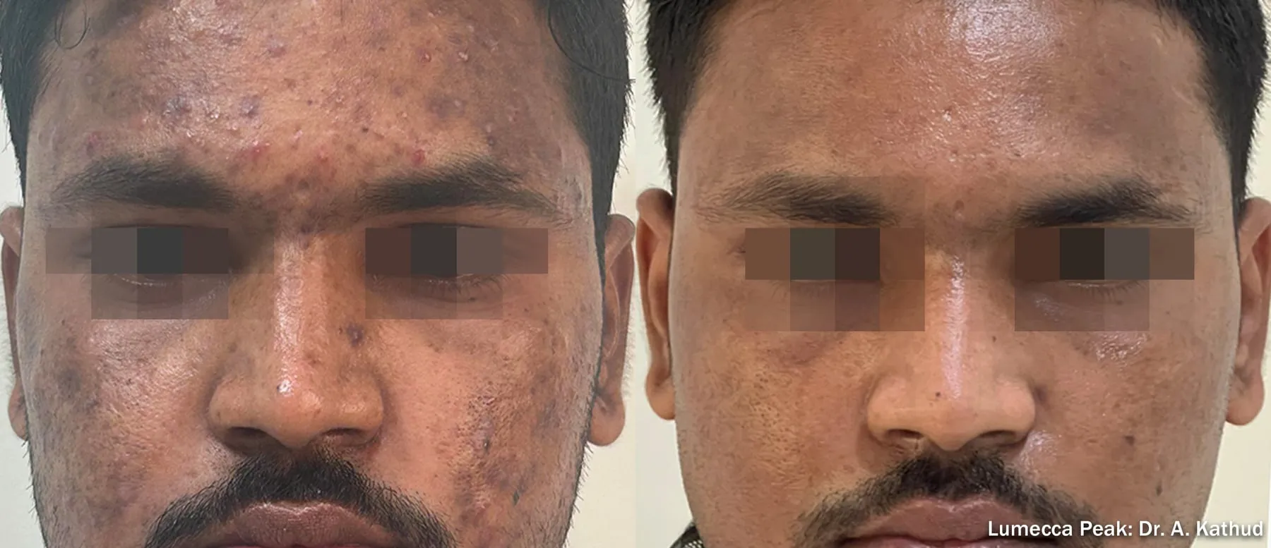 Lumecca IPL before and after on a man’s face: acne marks and post-inflammatory pigment visibly cleared