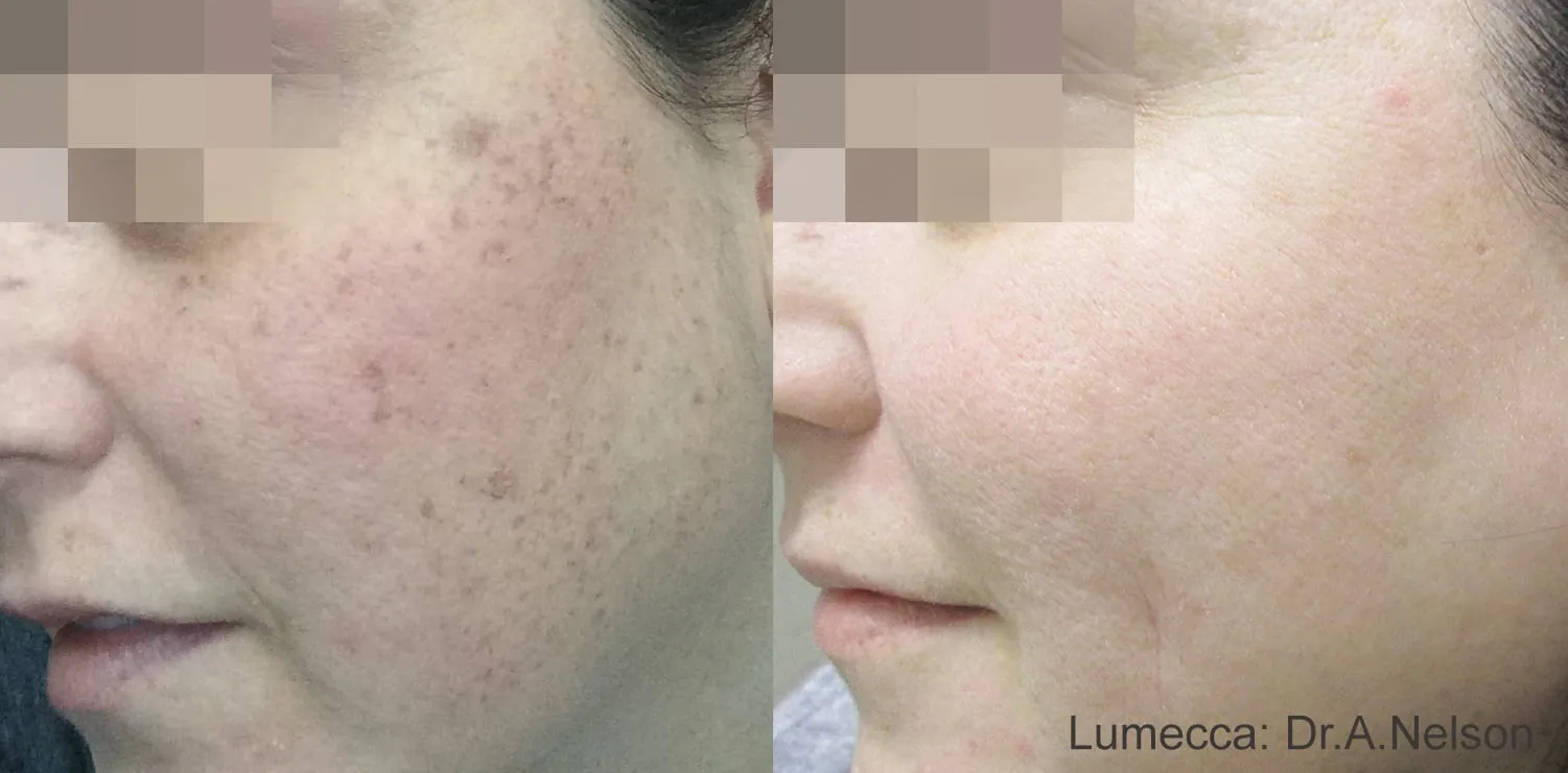Lumecca IPL before and after showing scattered cheek freckling and sun spots faded three weeks after one treatment