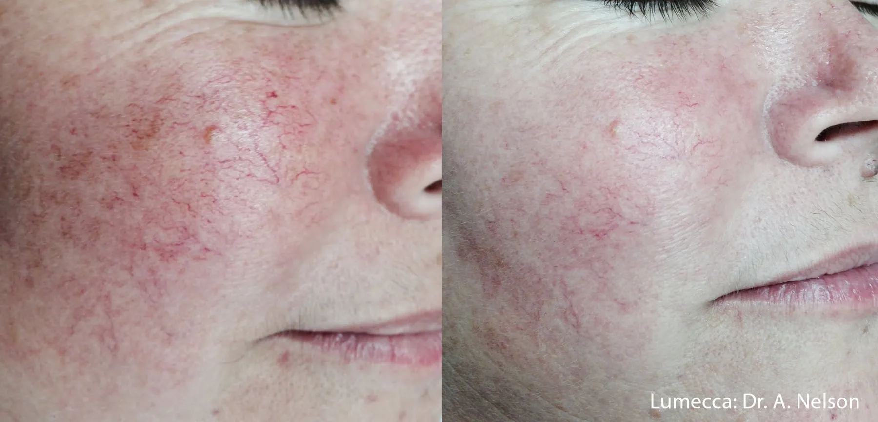 Lumecca IPL before and after: broken capillaries and diffuse cheek redness reduced after one treatment