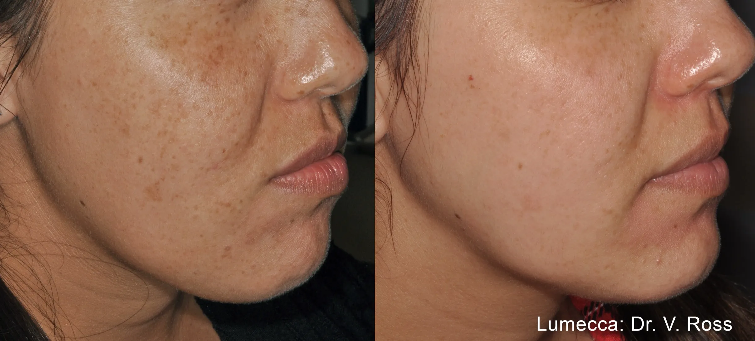 Lumecca IPL before and after showing cheek pigment cleared after one session