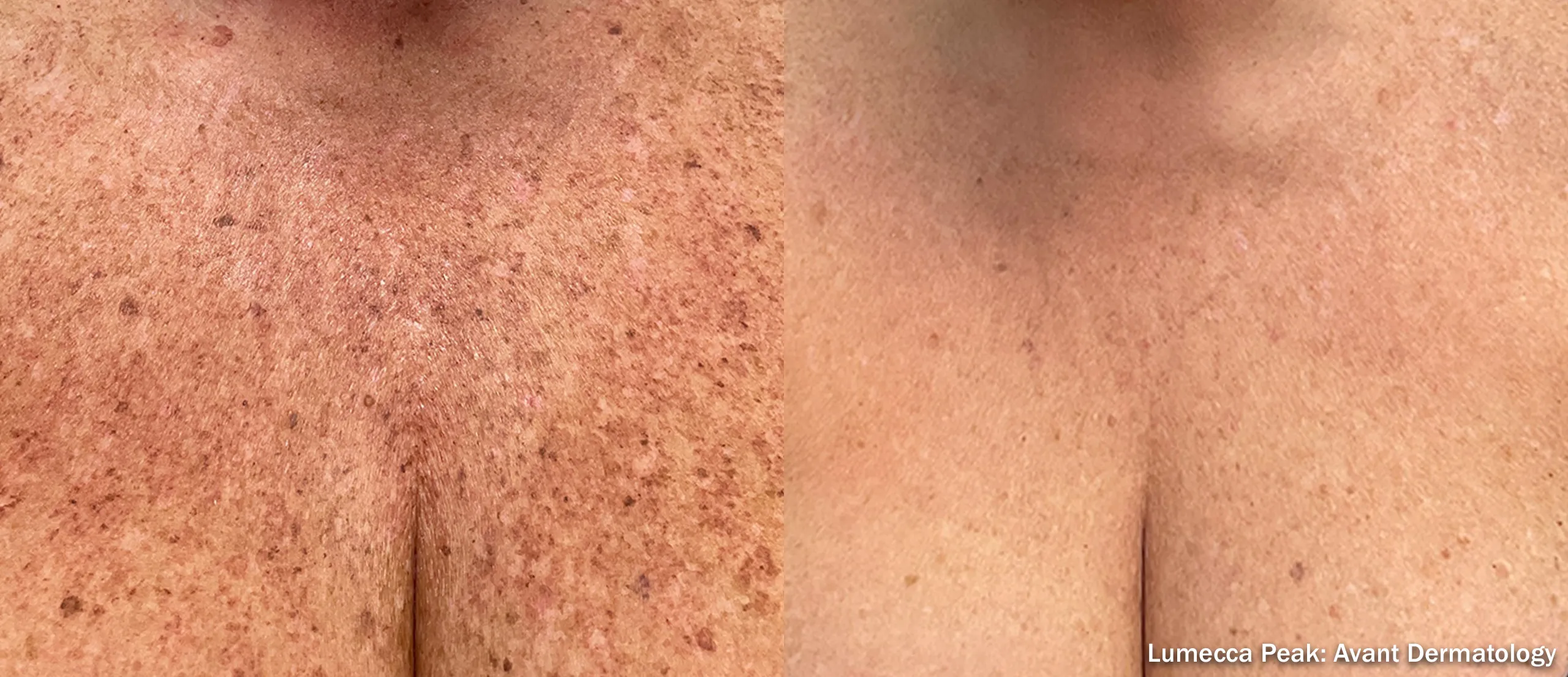 Lumecca IPL before and after clearing sun spots on the chest and décolletage