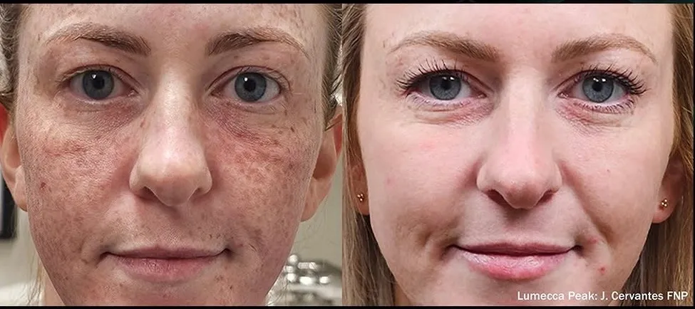 Lumecca IPL before and after clearing heavy facial freckling and sun damage
