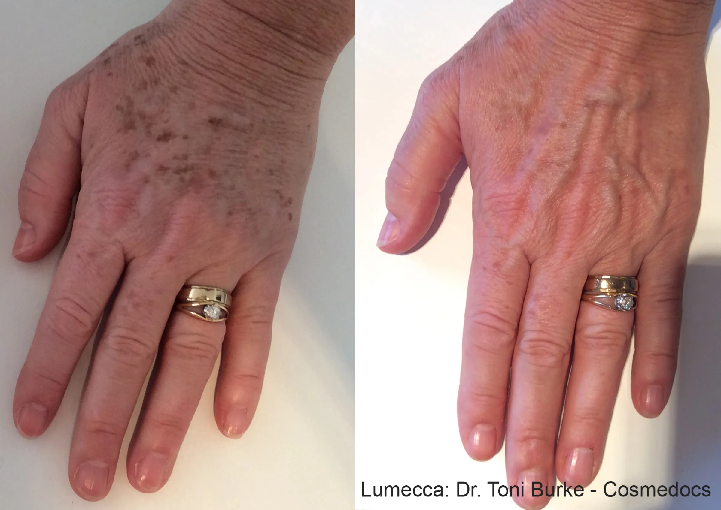 Lumecca IPL before and after fading age spots on the hands