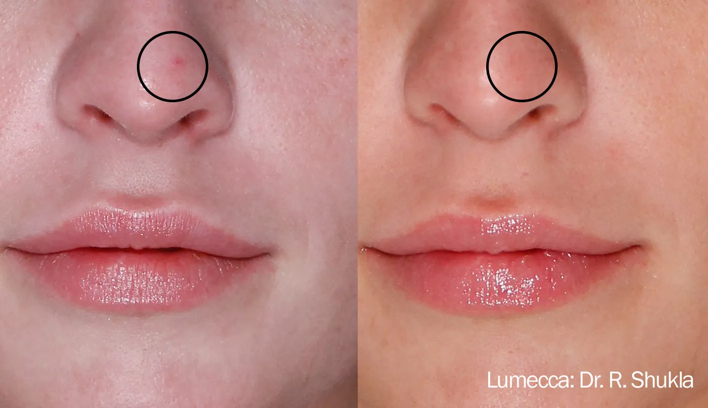 Lumecca before and after clearing a vascular spot on the nose