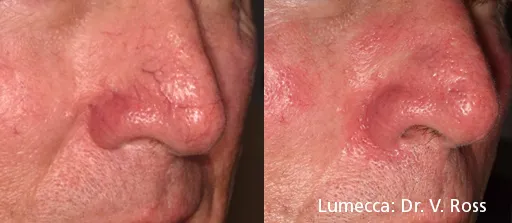 Lumecca IPL before and after reducing nose and cheek redness and broken capillaries