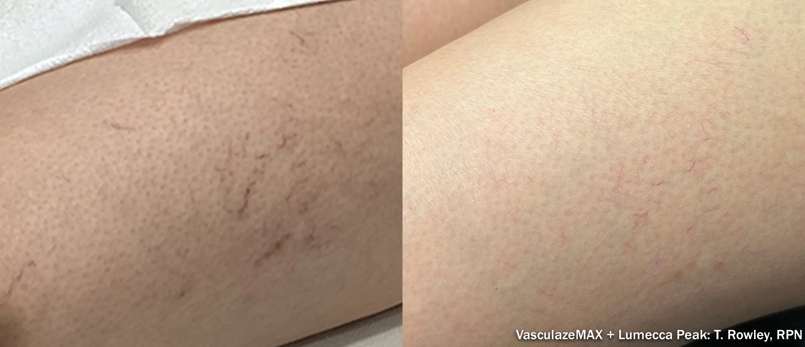 Lumecca IPL before and after treatment of vascular lesions on the leg