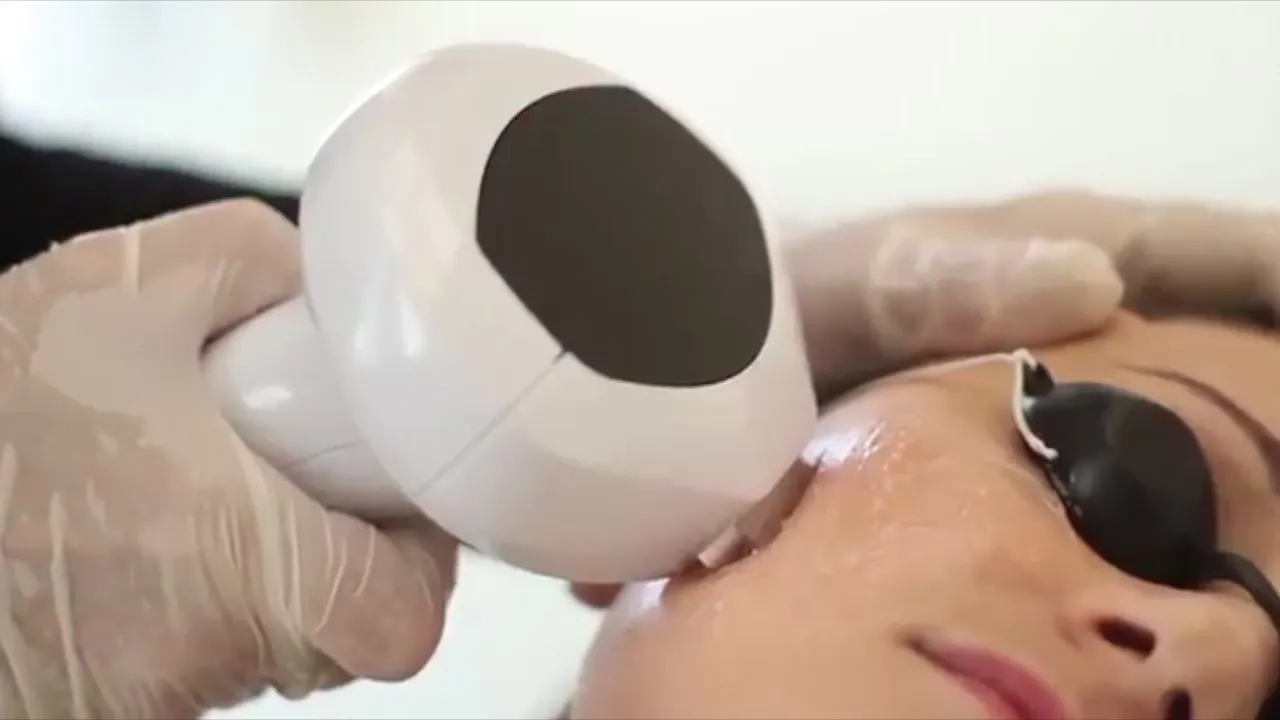 Lumecca IPL photofacial in progress, with the handpiece delivering light pulses to a client’s cheek