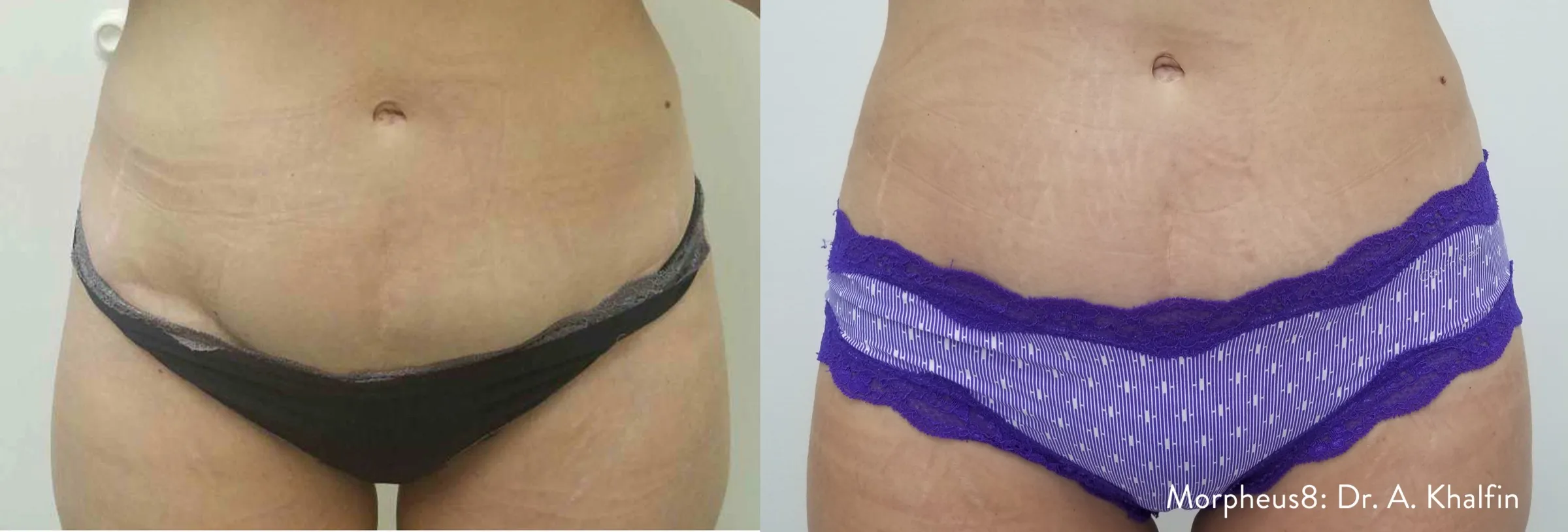 Morpheus8 before and after skin tightening on the abdomen