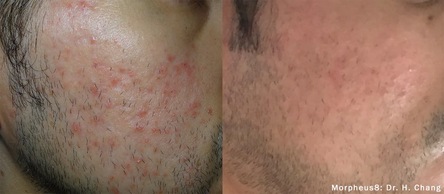 Morpheus8 before and after softening acne scarring on the cheek