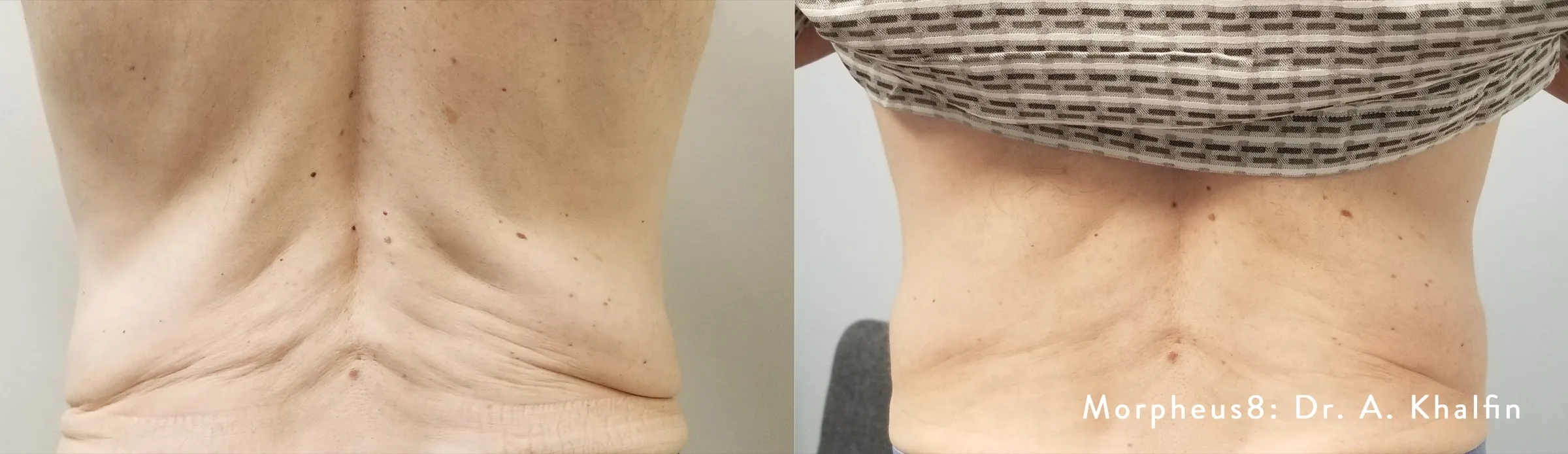 Morpheus8 before and after tightening lax skin on the back