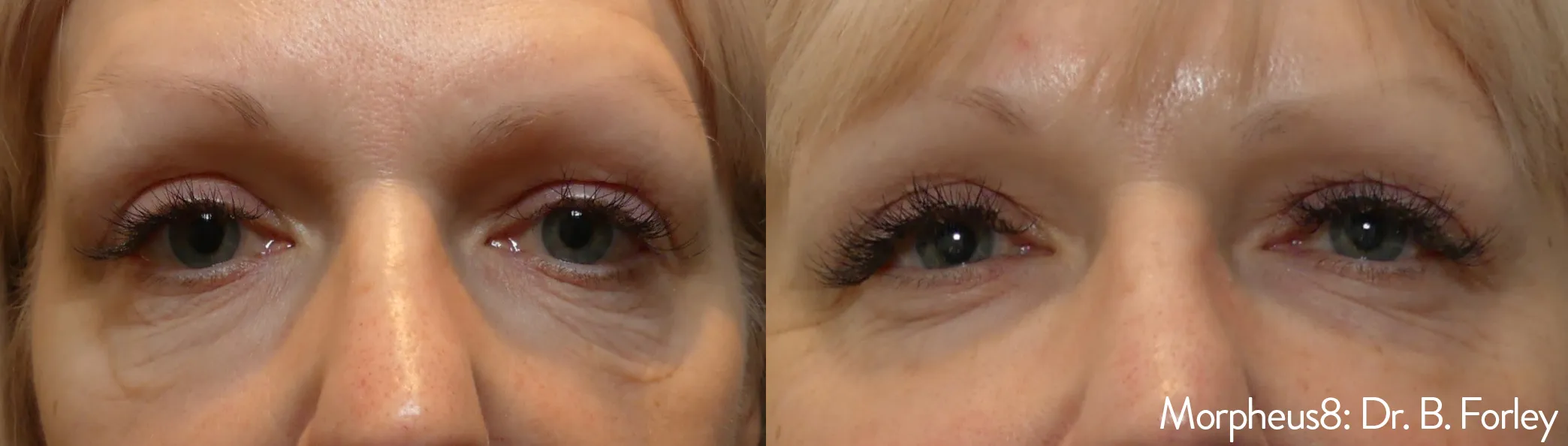 Morpheus8 before and after smoothing texture around the eyes