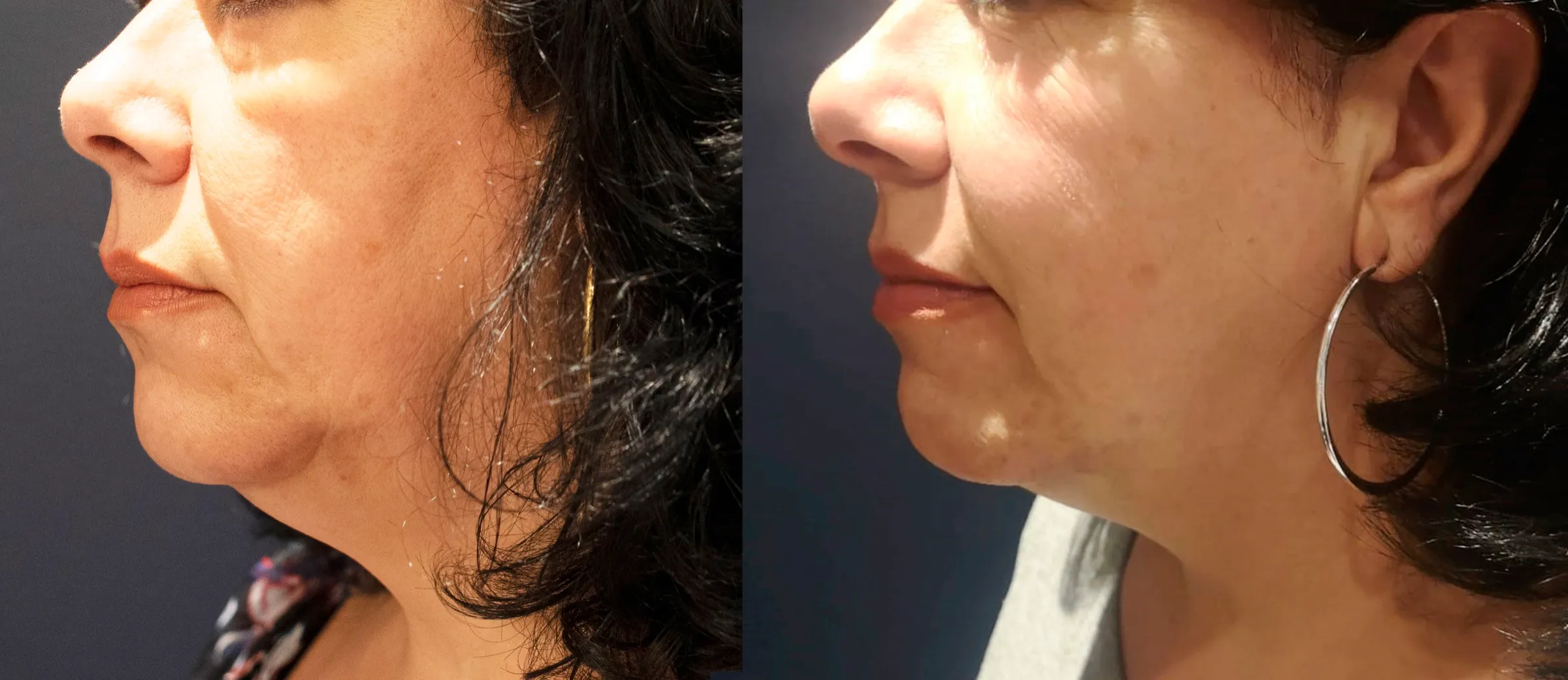 Morpheus8 before and after defining the jawline, three months post treatment