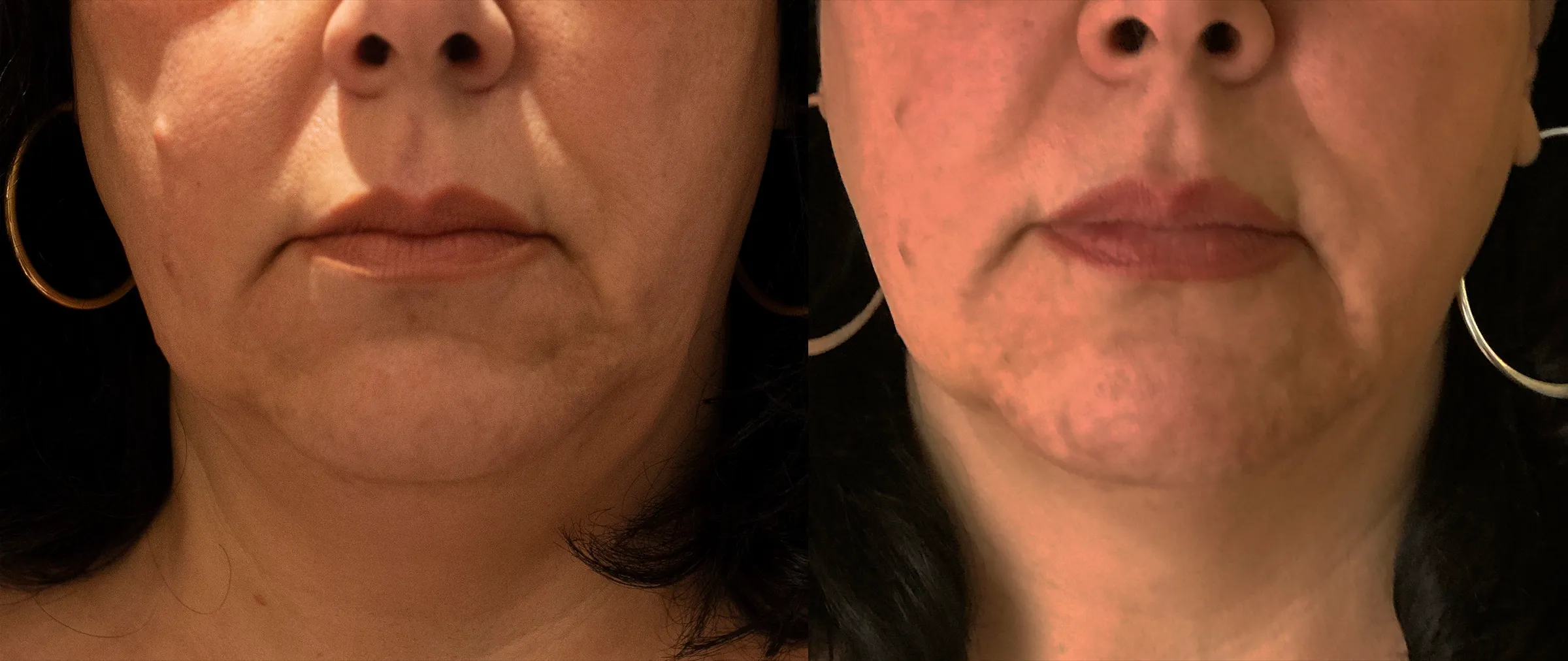 Morpheus8 before and after tightening the lower face, three months post treatment