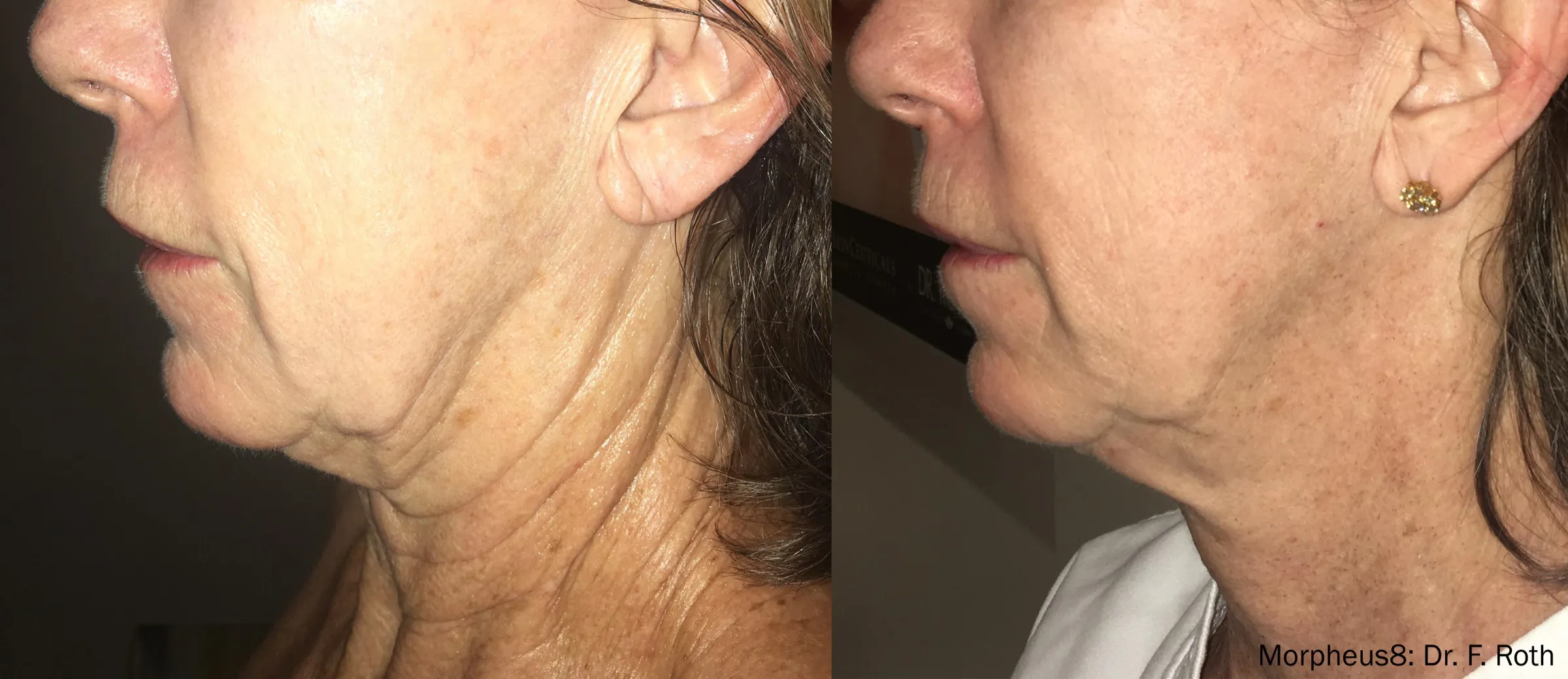 Morpheus8 before and after firming the neck and jawline, side profile