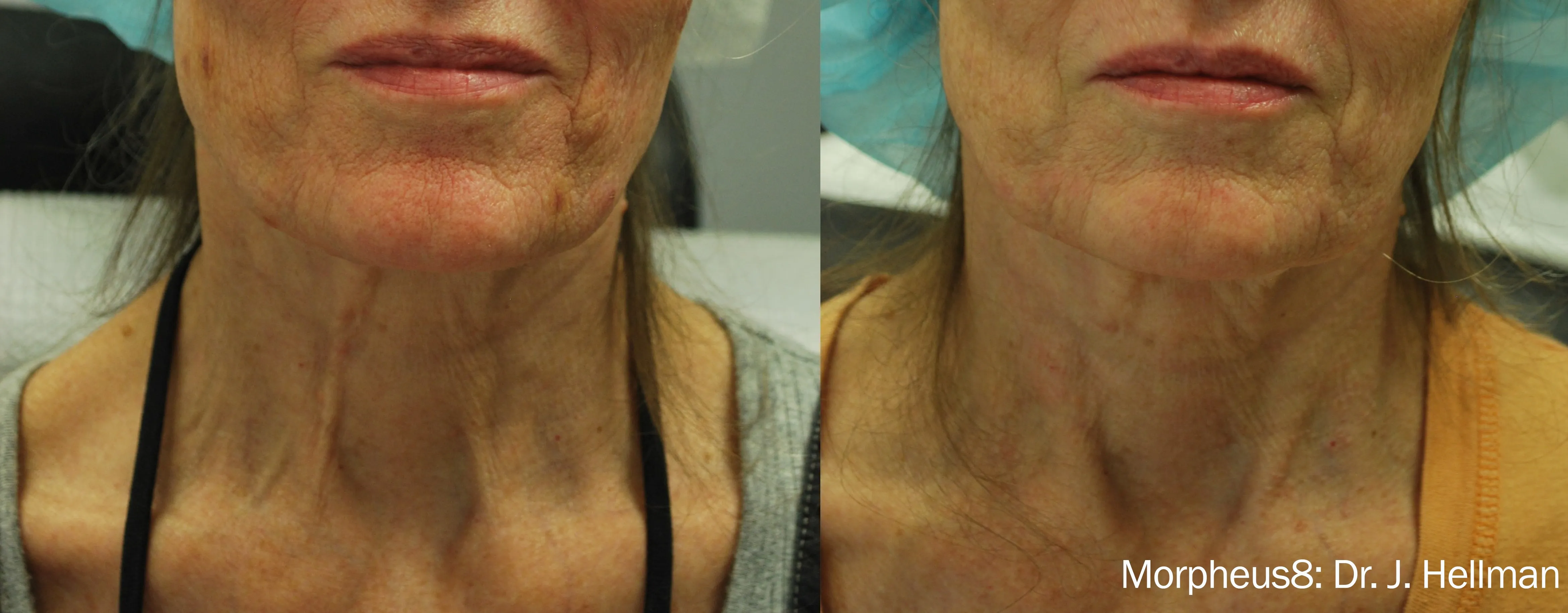 Morpheus8 before and after reducing neck laxity and wrinkles