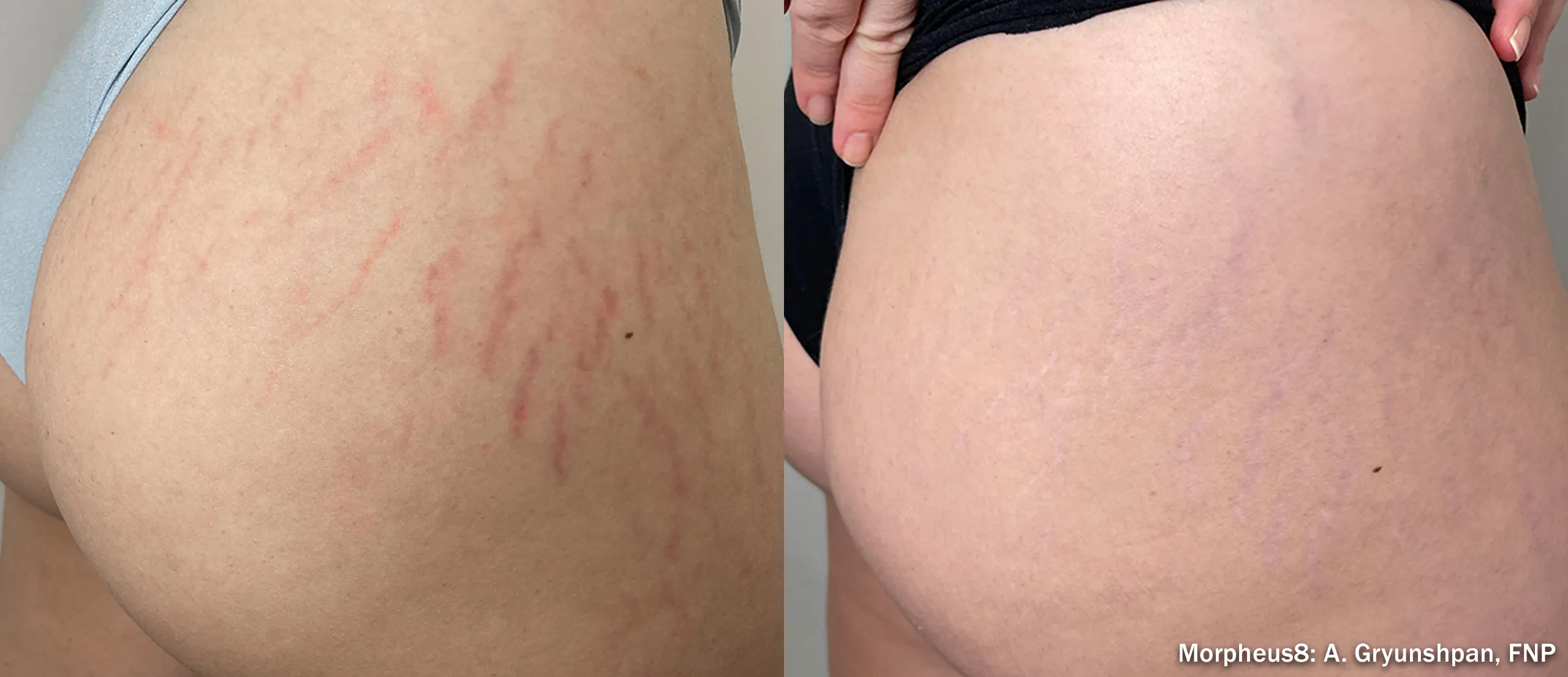 Morpheus8 before and after improving stretch marks on the thigh