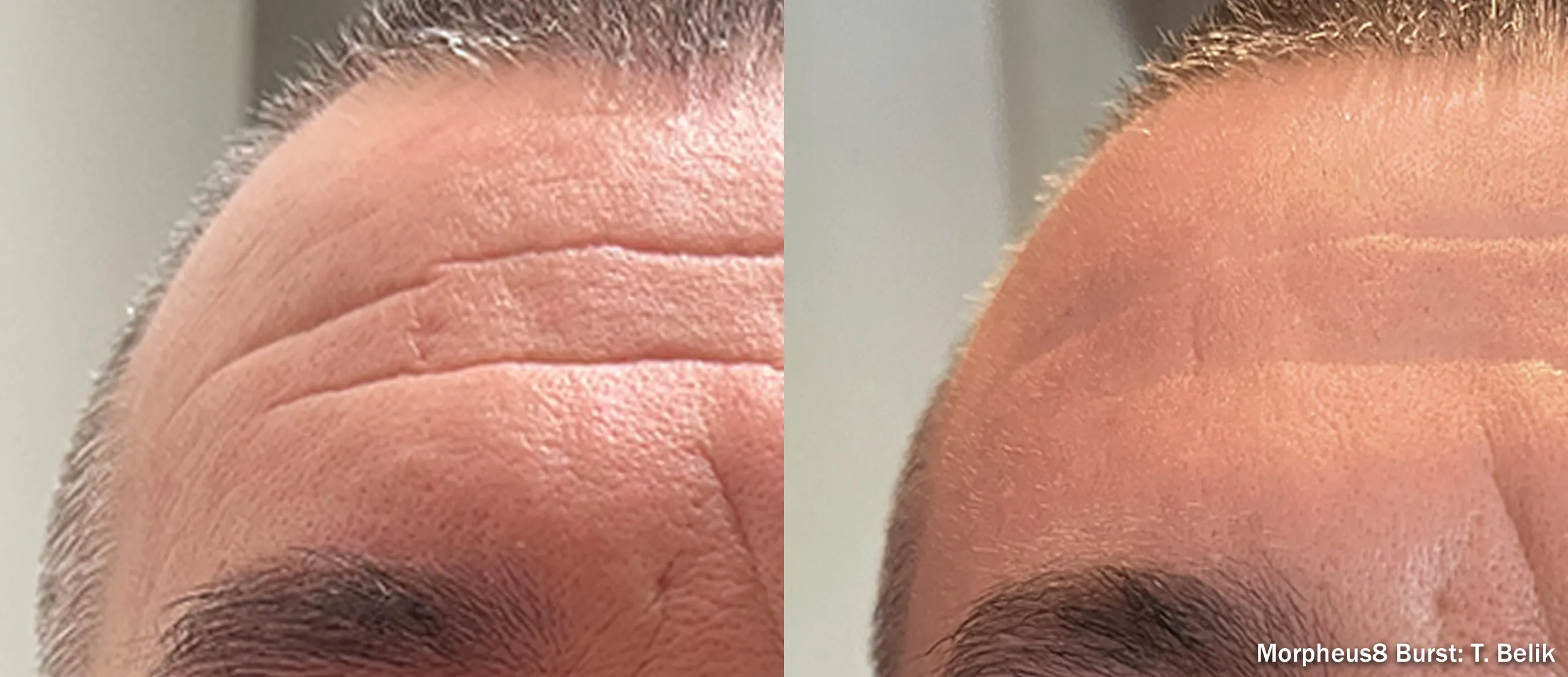 Morpheus8 before and after softening forehead lines