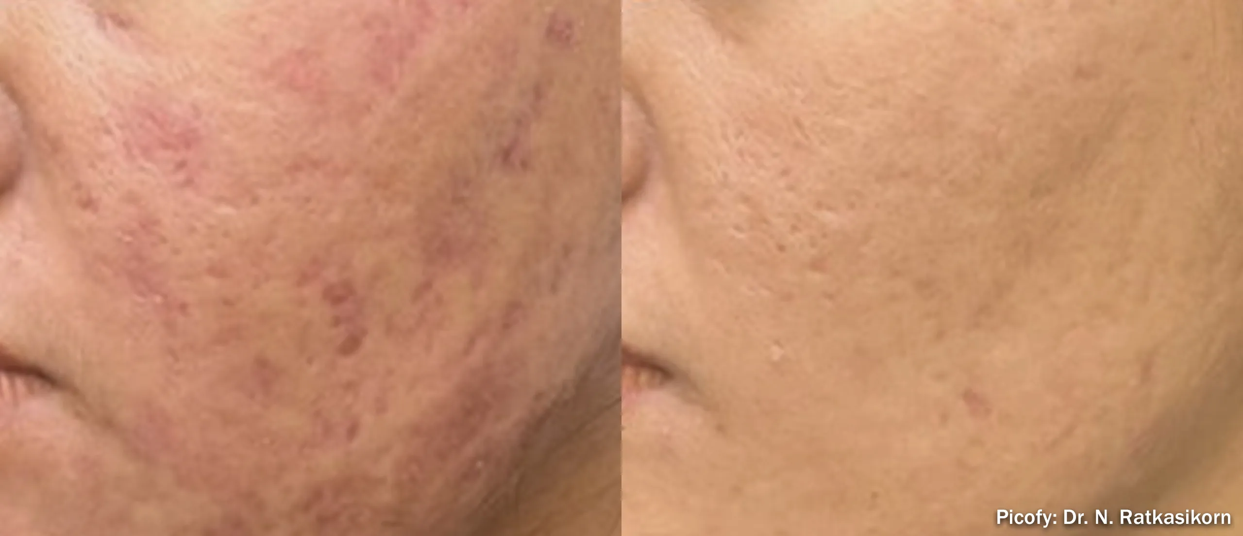 Picofy picosecond laser before and after softening acne scarring