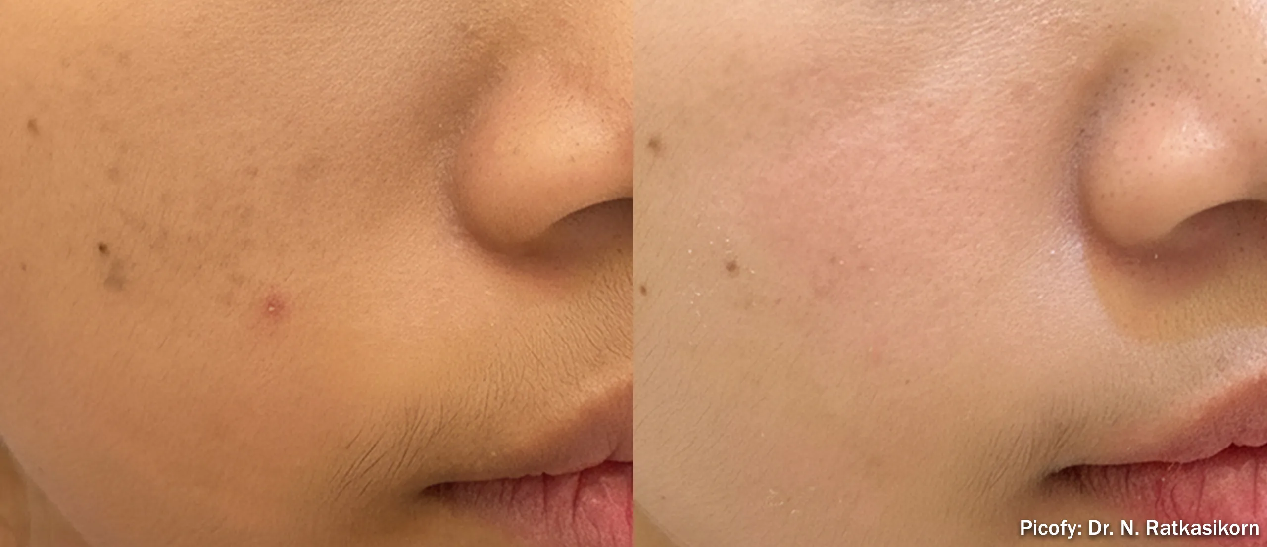 Picofy picosecond laser before and after clearing facial pigment and sun spots