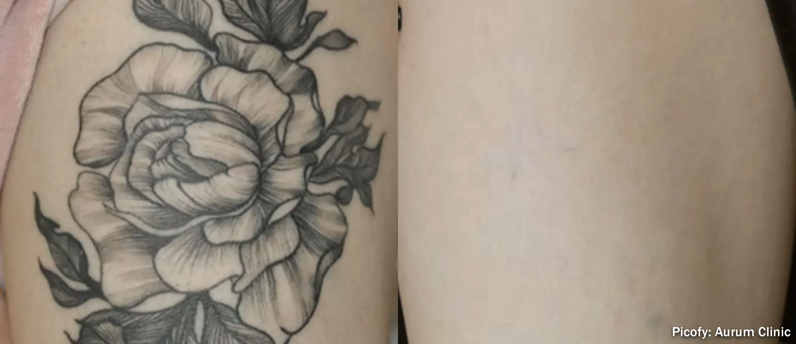 Picofy picosecond laser before and after showing near-complete removal of a flower thigh tattoo