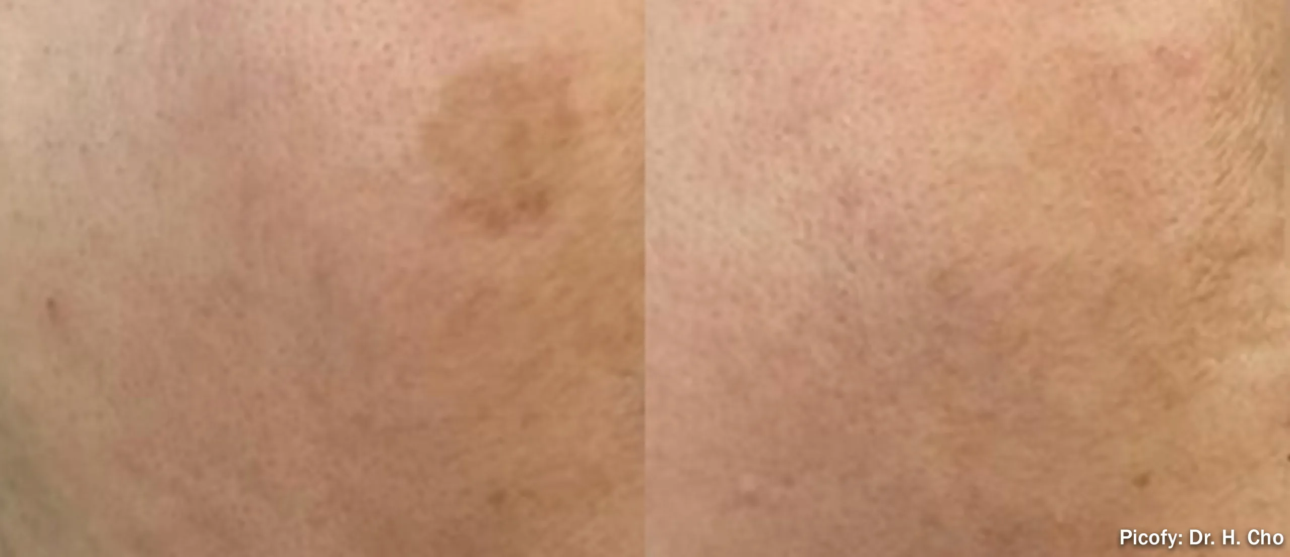 Picofy picosecond laser before and after clearing melasma on the face