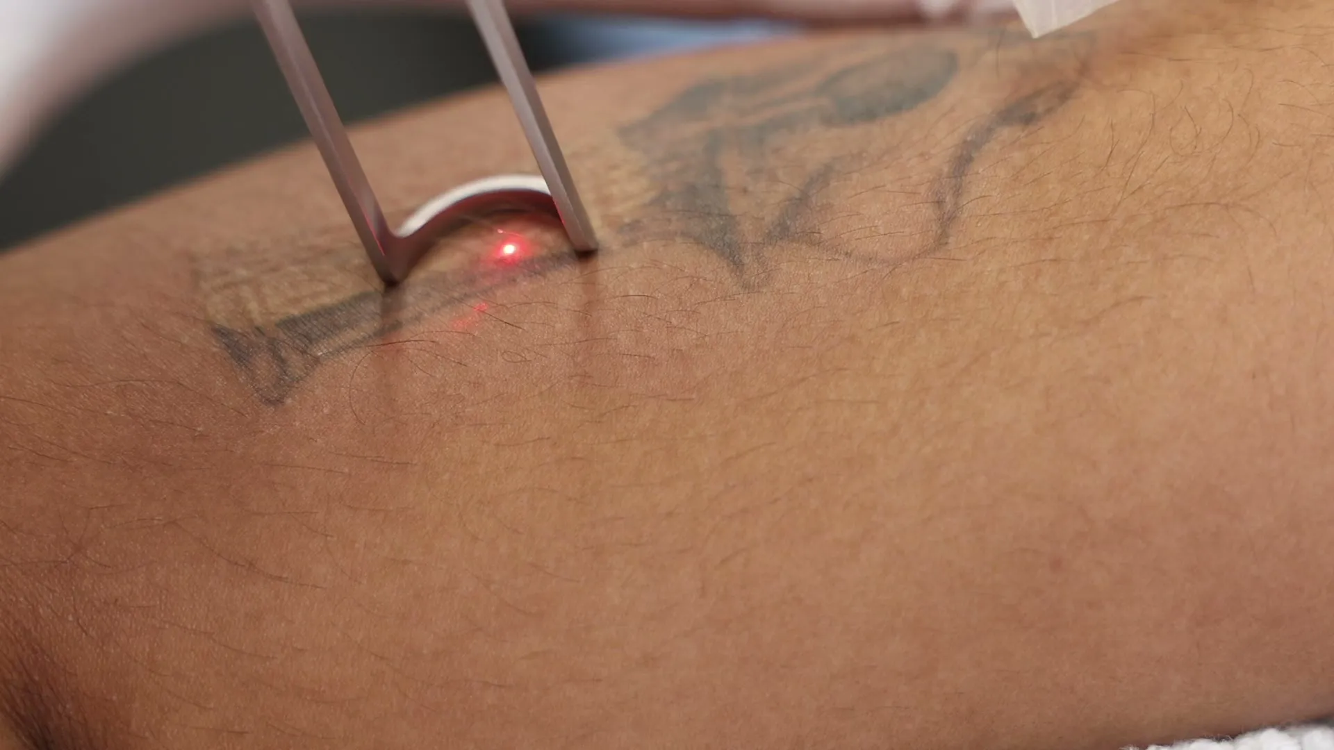 Picofy picosecond laser aiming beam passing over a fading tattoo during a removal session