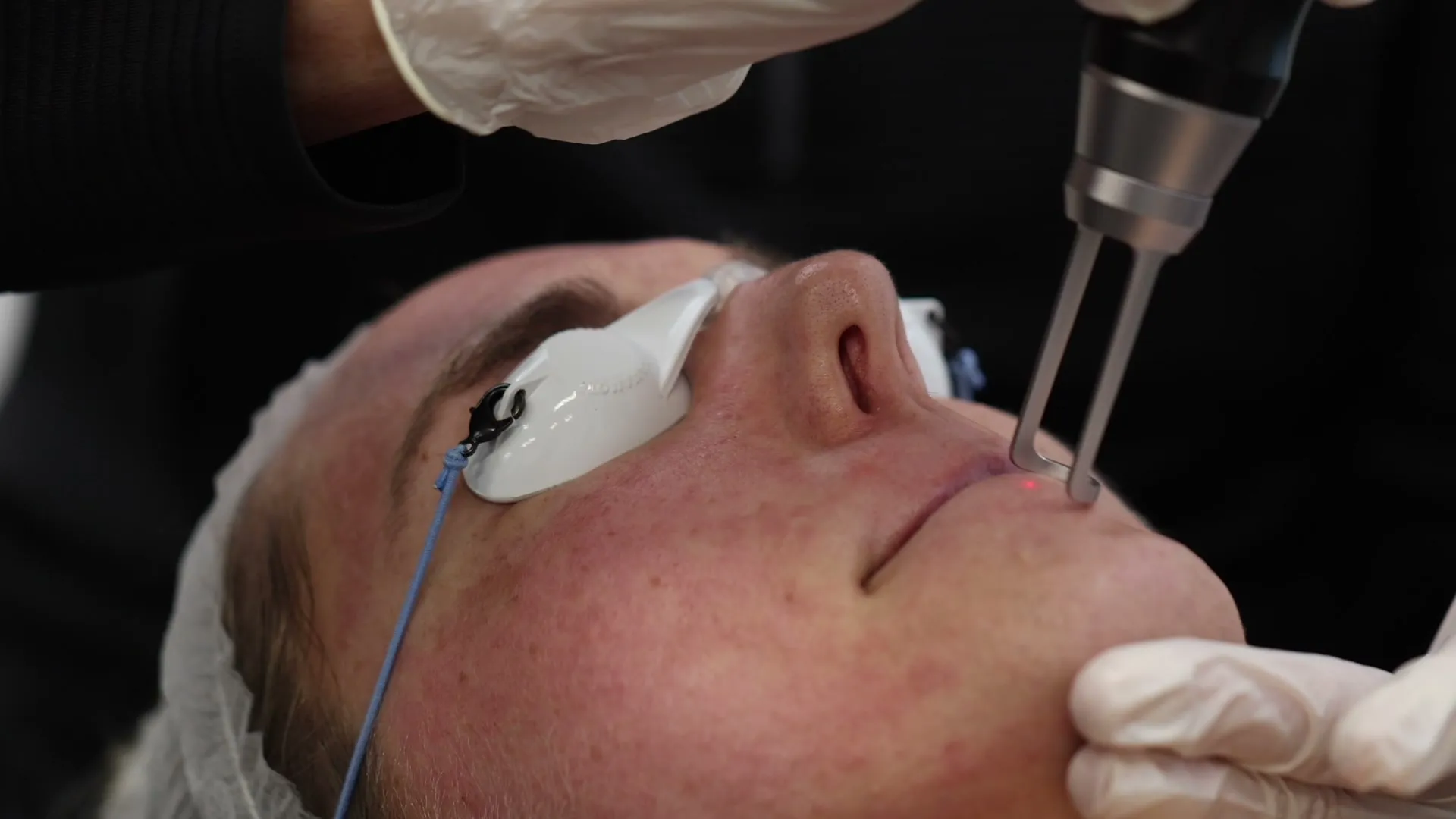 Client receiving a Picofy picosecond laser facial treatment with protective eye shields