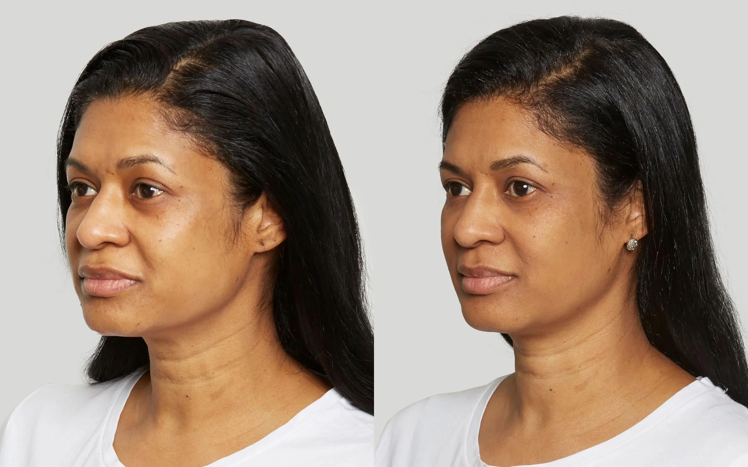 Sculptra before and after: restored midface volume, softer nasolabial folds and a firmer jawline at 14 weeks