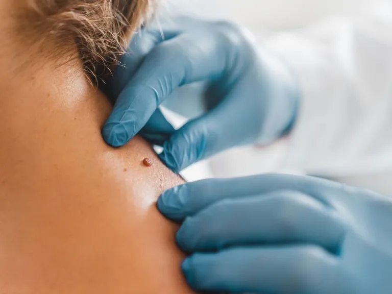 Smooth neck and jawline after professional skin tag removal
