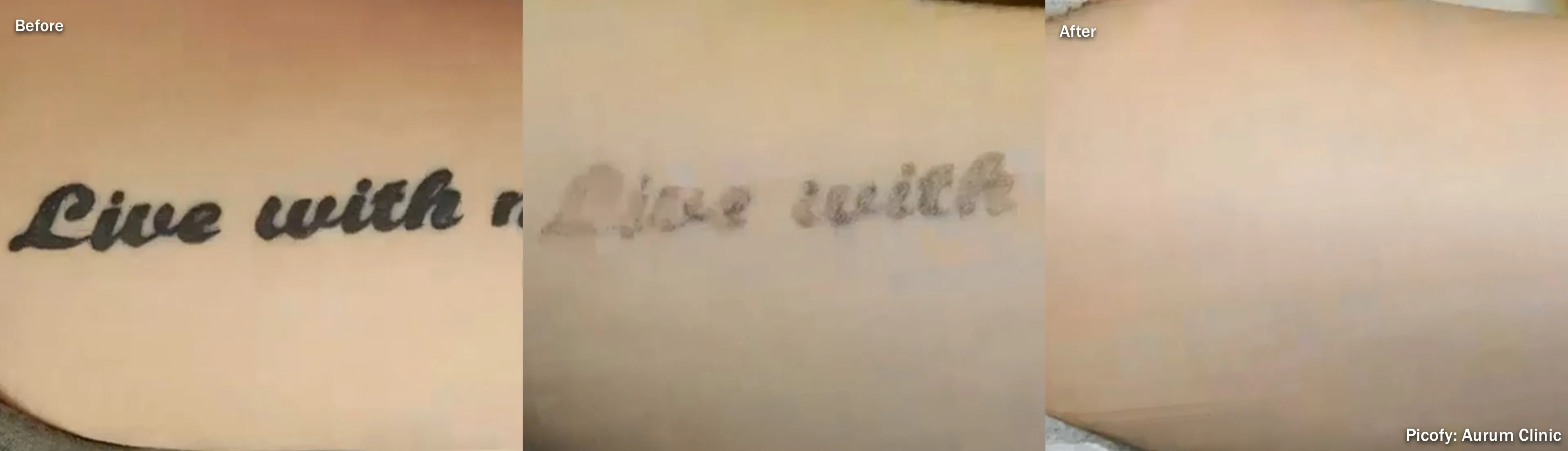 Three-stage progression of Picofy laser removal of a script arm tattoo