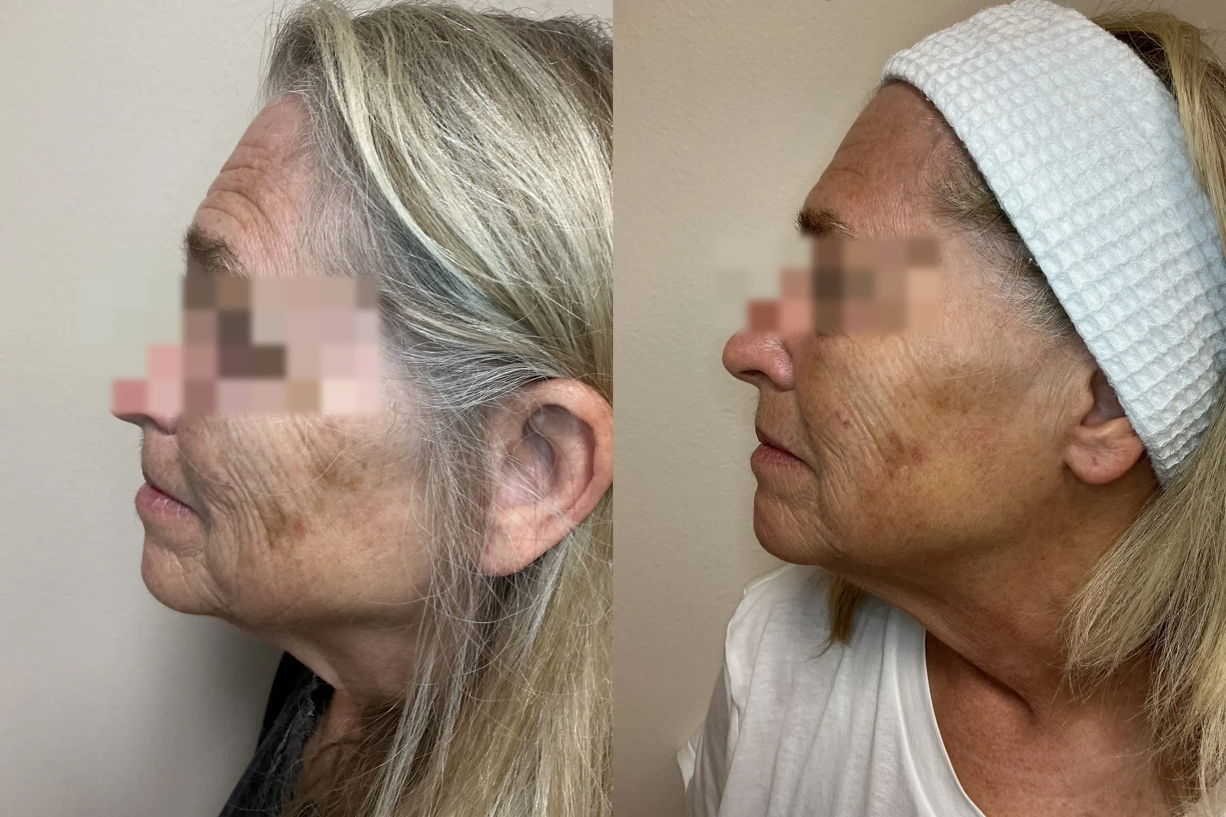 Left profile before and after three VI Precision Plus peels and two microneedling with exosomes treatments, showing softened texture along the cheek and jawline
