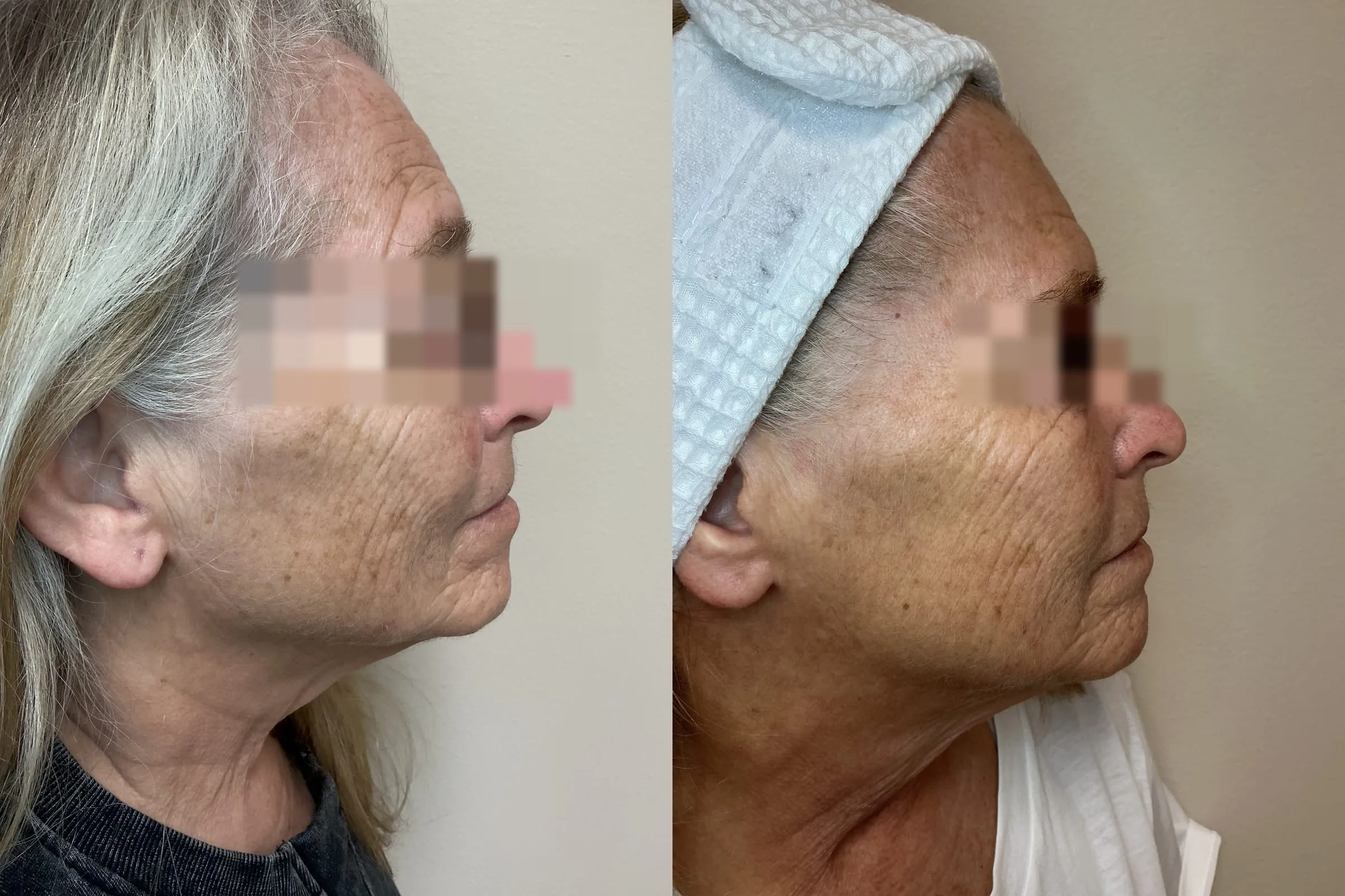 Right profile before and after three VI Precision Plus peels and two microneedling with exosomes treatments, showing more even tone across the cheek