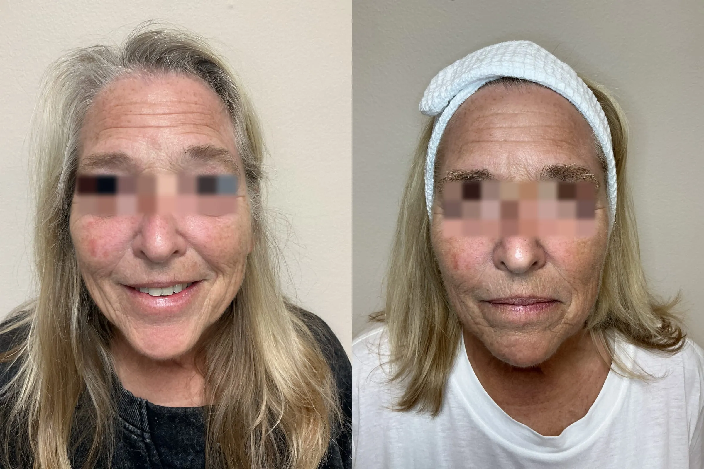 Front view before and after three VI Precision Plus peels and two microneedling with exosomes treatments, showing a smoother, more even complexion