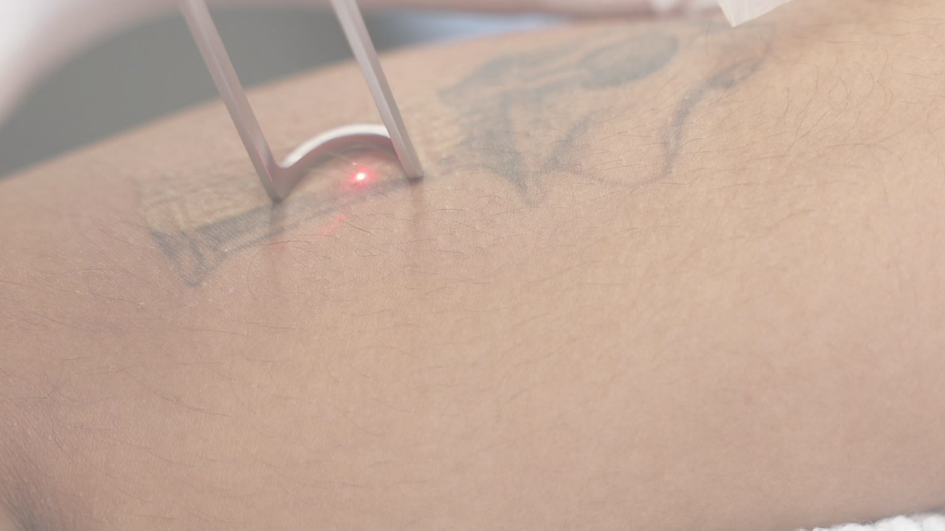 Pico laser tattoo removal treatment at SkinCredible Wichita KS
