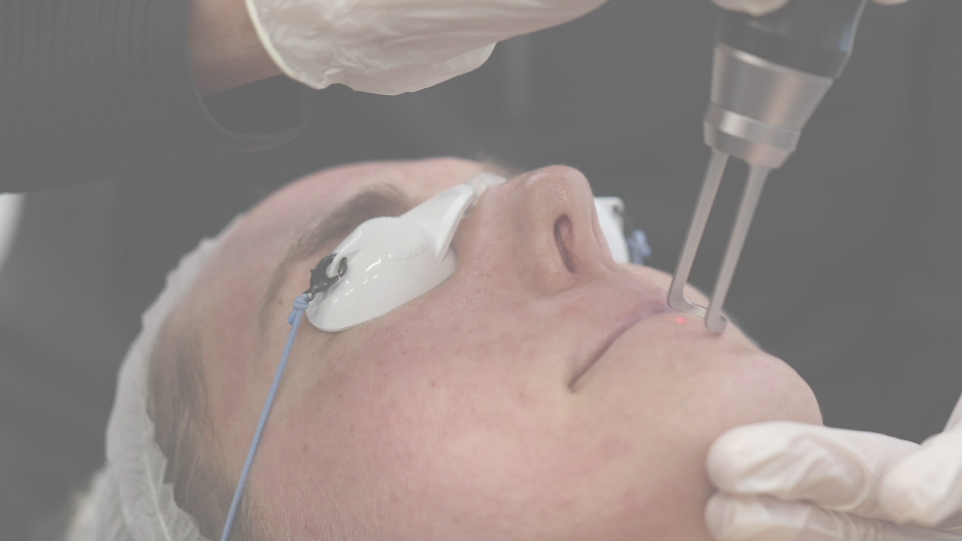 Picofy pico laser melasma treatment before and after Wichita KS